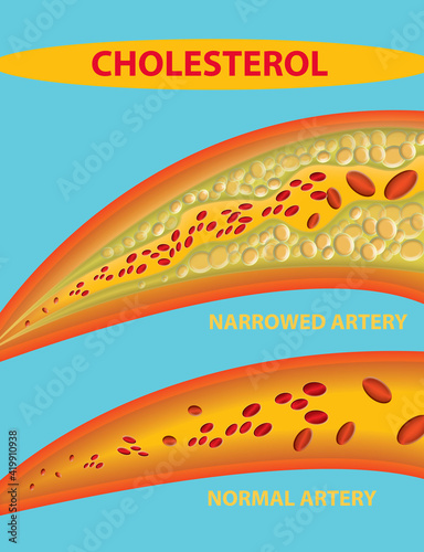 Blocked blood vessel - artery with cholesterol