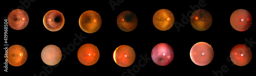 SET of Photo Madical Retina Normal isolated on black background.Retina of diabetes , diabates retinopathy. photo