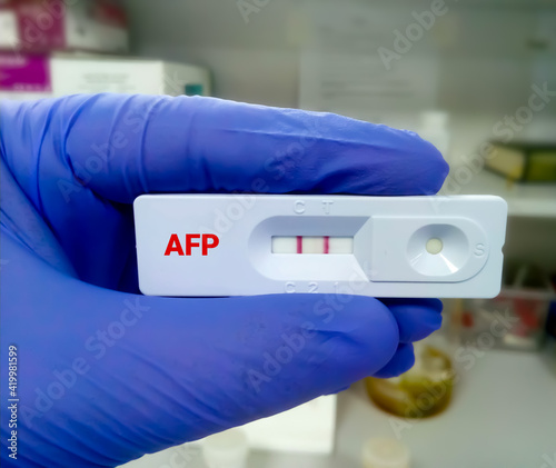 Rapid diagnostic test for AFP test (liver cancer diagnosis) with a positive result. Rapid test cassette photo