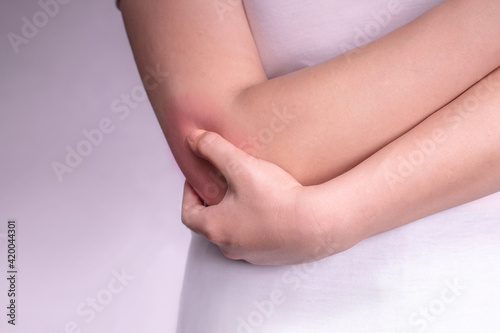  the girl holds a bruised reddened elbow