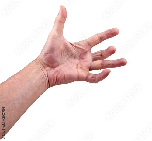 Hand of an man with Dupuytren contracture disease