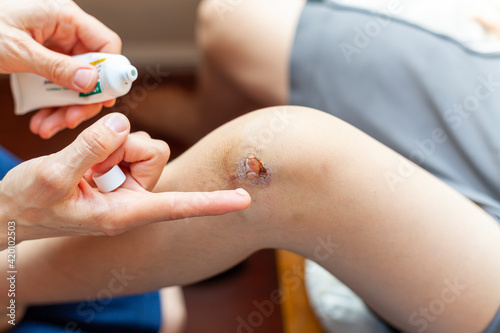 Εκτύπωση καμβά A mother is applying topical antiseptic and anti inflammatory cream onto bruised skin over the knee cap of her son