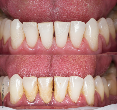 before and after picture for teeth cleaning