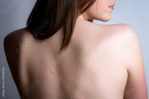 Wallpaper Mural Female back with acne, red spots, pimples. Young girl with a magnifying glass on gray background. Skin diseases. Torontodigital.ca