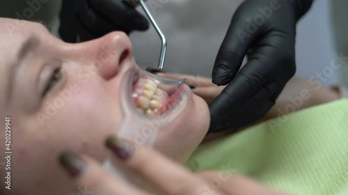 young beautiful caucasian lady at the dentist appointment. the dentist installs a labial retractor to the patient. side view. 4k