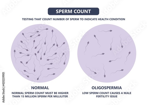 in vitro fertilization IVF semen test sample sperm count type Male biopsy fertility collect Low Poor Zero head anatomy midpiece tail birth control blocked defect abnormal ejaculate vas Non dry