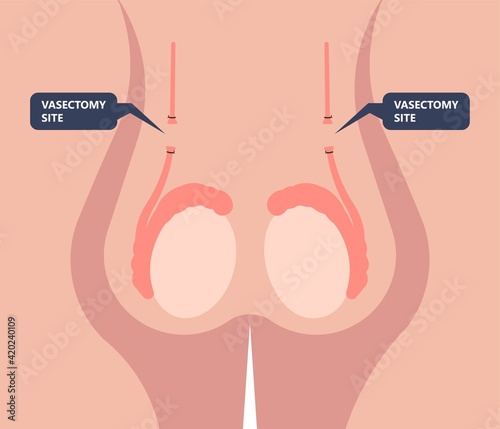 in vitro fertilization IVF semen test sample sperm count type Male biopsy fertility collect Low Poor Zero head anatomy midpiece tail birth control blocked defect abnormal ejaculate vas Non dry