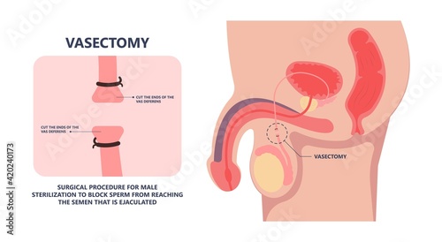 in vitro fertilization IVF semen test sample sperm count type Male biopsy fertility collect Low Poor Zero head anatomy midpiece tail birth control blocked defect abnormal ejaculate vas Non dry