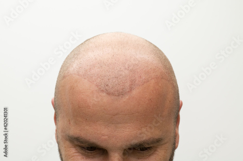 man after hair implant therapy