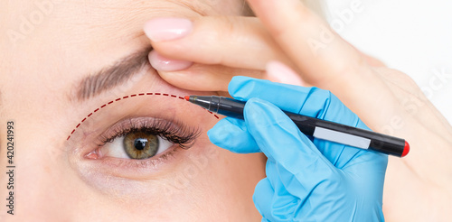 woman shows drooping eyelid for plastic surgery. Doctor plastic surgeon marks with a felt-tip pen a marker for a surgical operation photo