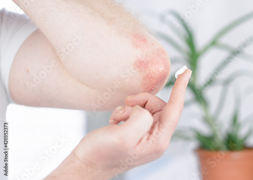 A man applies a cream to the elbow affected by psoriasis