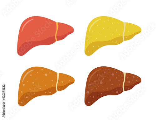Stages of nonalcoholic liver damage. Healthy, fatty, fibrosis, cirrhosis. Liver Disease. Isolated vector illustration in flat style on white background