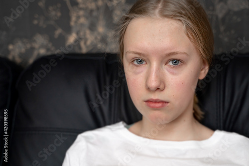 the portrait of pimply teenager girl with blue eyes and blond hair in white t-shirt