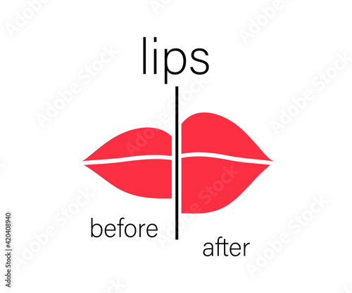 Lips before and after botox injection. Symbol. Vector illustration.