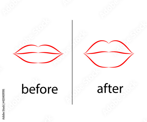 Lips before and after botox injection. Symbol. Vector illustration.