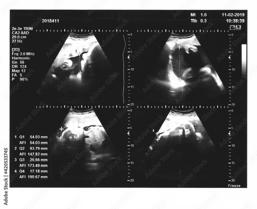 Sonogram measuring amniotic fluid Stock Photo Adobe Stock
