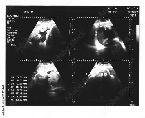 Sonogram measuring amniotic fluid photo