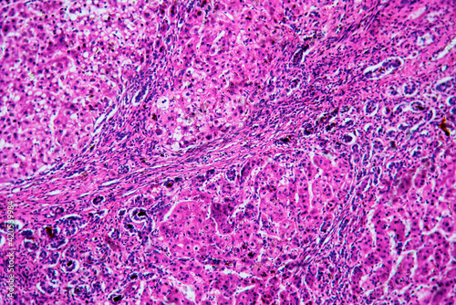 ill human liver cells of biliary cirrhosis photo