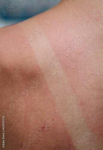 Sunburn shoulder detail. photo