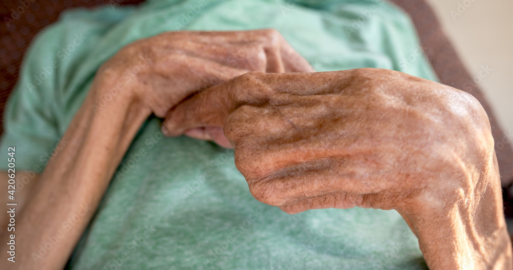 Fototapeta premium The elderly patient's hand is bent