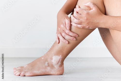 Woman with vitiligo photo