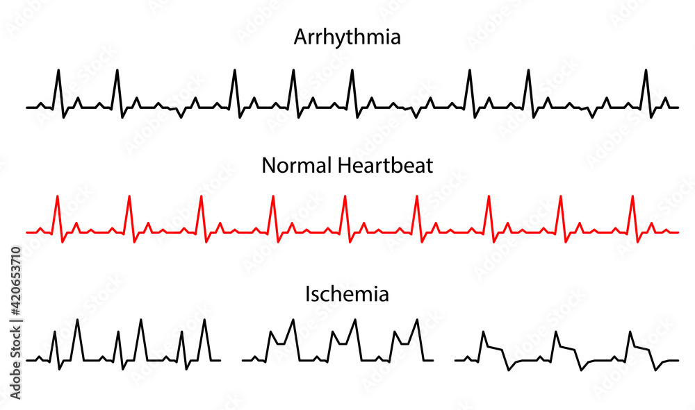 Set Lines heartbeat normal, arrhythmia and ischemia.