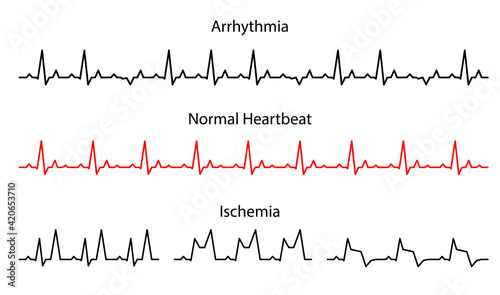 Set Lines heartbeat normal, arrhythmia and ischemia.