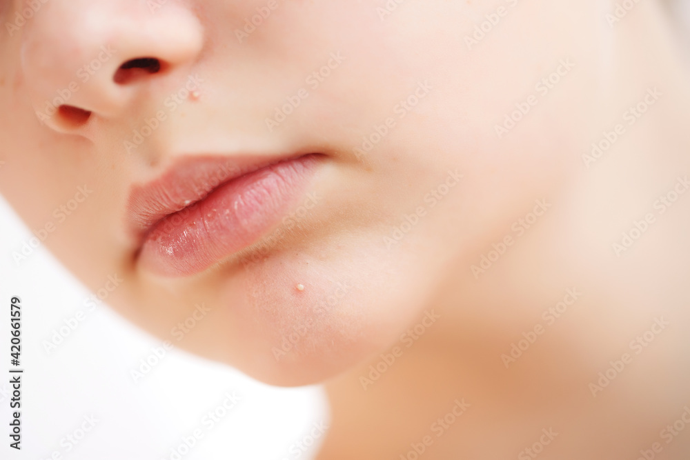Obraz premium Teenage acne on the chin. Close up face with pimple. Teen problem. High quality photo.