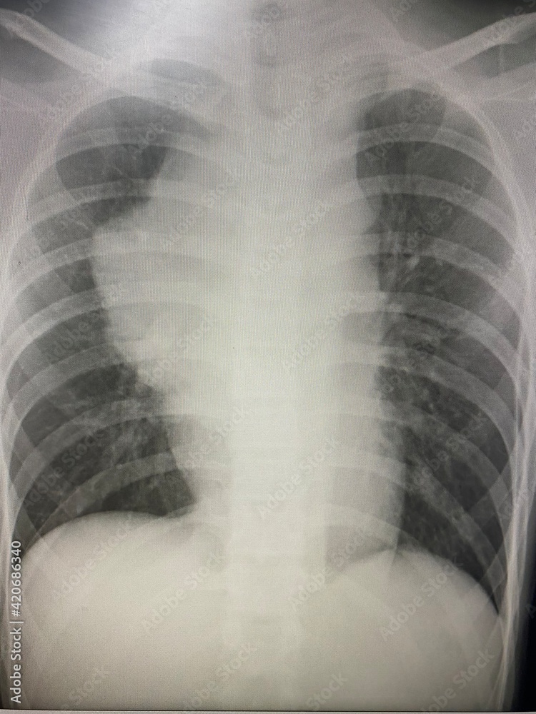 Film chest Xray show mass at anterior mediastinum rule out lung tumor