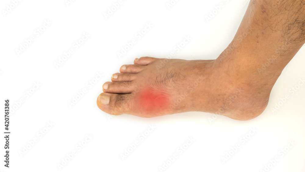 Foto de Foot disease Rheumatism and gout. Red leg swelling. Pain in the