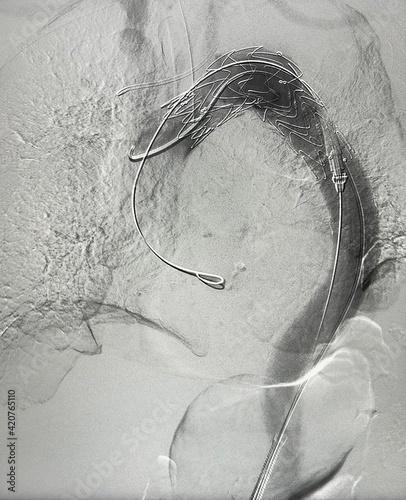 Angiogram of  Thoracic endovascular aortic repair (TEVAR).	
