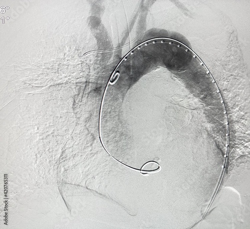Angiogram of aorta shown aortic dissection type B at descending aorta during Thoracic endovascular aortic repair (TEVAR). photo