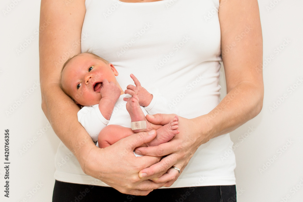 Fotka „Neonatal jaundice yellowish discoloration of the white part of