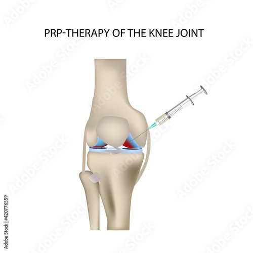 Knee PRP therapy, vector medical illustration