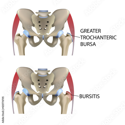 Hip bursitis, vector medical illustration photo