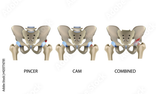 Femoroacetabular impingement, hip joint diseases, realistic medical vector illustration