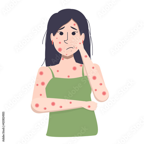 Vector illustration of a young Asian woman with itchy, blistered skin. The symptom of measles or chickenpox acne.