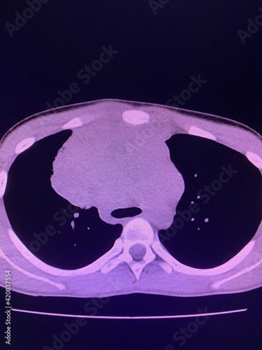 CT scan show heterogeneous mass at interior mediastinum , the mass slightly invade proximal lower part of svc for medical and technology concepts  photo