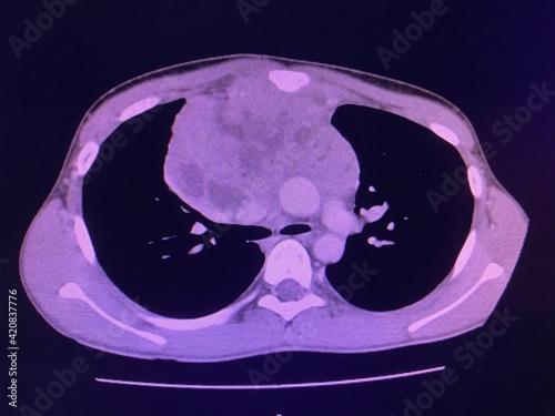 CT scan show heterogeneous mass at interior mediastinum , the mass slightly invade proximal lower part of svc for medical and technology concepts  photo
