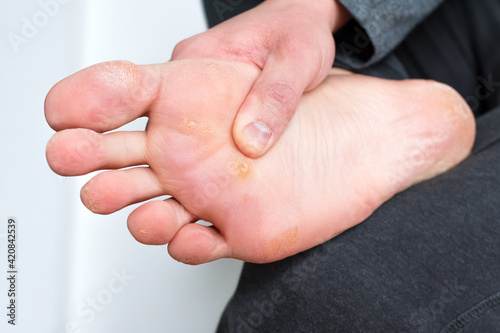Foot with corns, calluses and dry skin, wart plantar verrucas. Verrucas papilloma callus virus, disease on foot skin. Unhealthy foot leg with corn close up. Man shows callosity before treatment photo