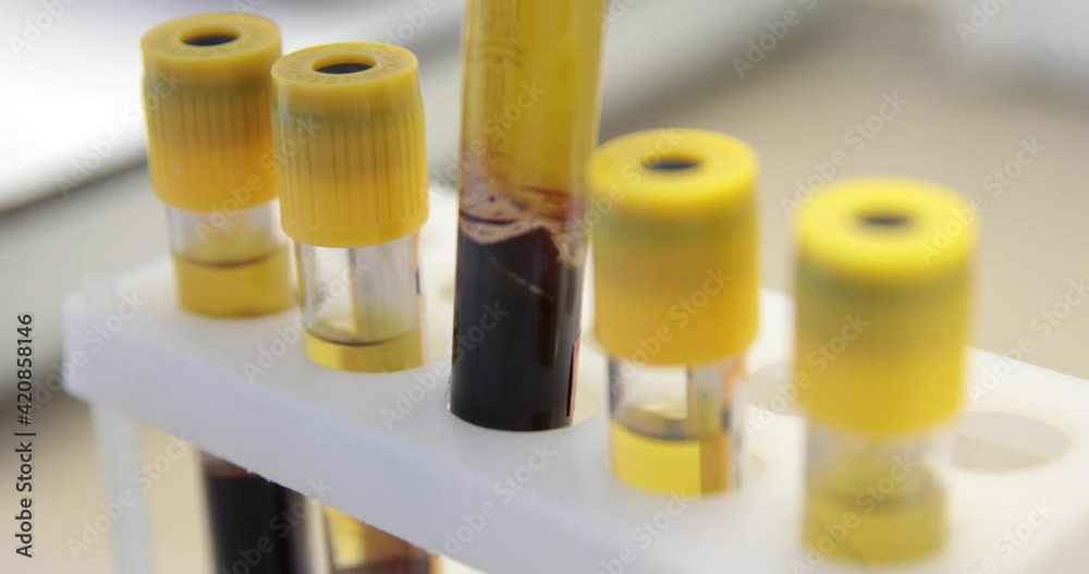 Identify Test Tube Study of blood serum in test tubes in the laboratory. Tests for the ...