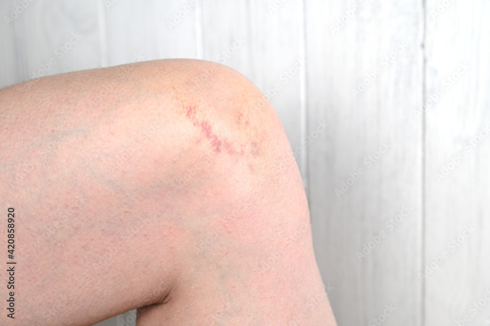 Fototapeta premium Knee injury after impact. Bruising on the knee joint.