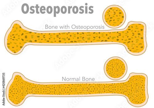 Osteoporosis, porous bone. Bone anatomy, structure. Comparison of normal and osteoporotic bone, cross section. Skeletal illustration vector