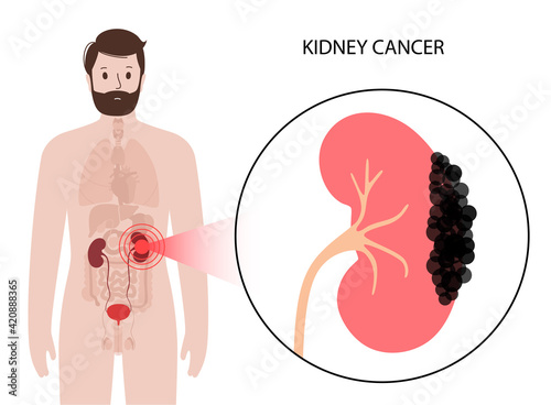 Kidney disease concept