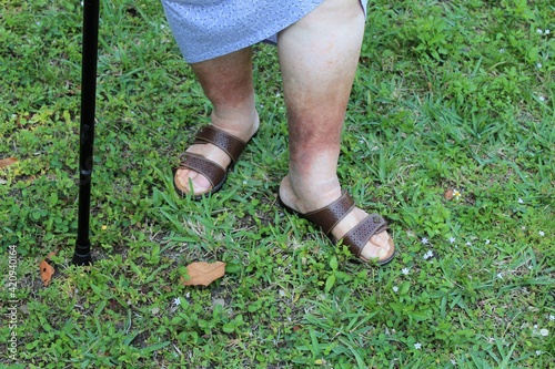 A woman's legs are shown, she is suffering from Chronic Venous Insufficiency with mild cellulitis in her legs. She is walking and exercising to relieve heaviness, swelling, pain  redness in the leg. photo