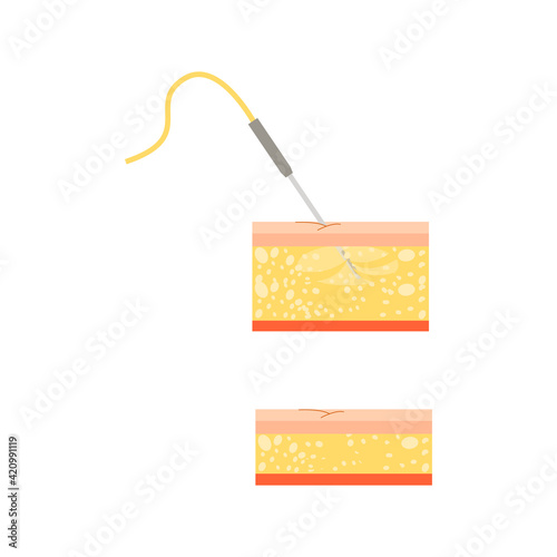 Cosmetic Skin Injection Composition