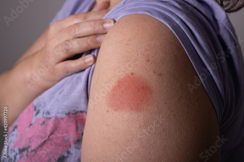 Redness after a Covid vaccination with a vaccine