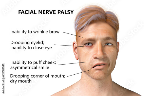 Facial nerve paralysis, Bell's palsy photo