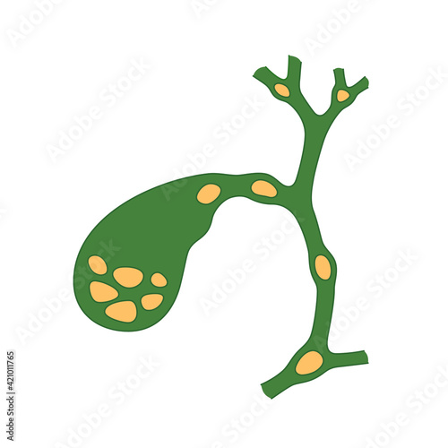 Variants of the location of stones in the gallbladder and bile ducts. Schematic drawing for cholelithiasis, gallstone disease. Isolated vector illustration on white background photo