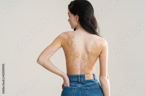 Young half-naked woman with vitiligo posing on camera photo